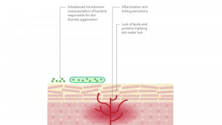 Role of skin microbiome in atopic dermatitis